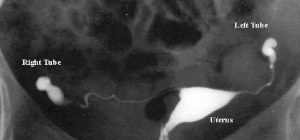 HSG showing a normal uterus and blocked tubes