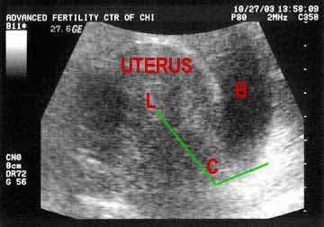 ultrasound image of uterus