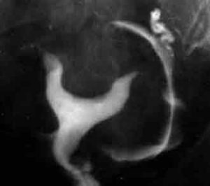 Hysterosalpingogram picture showing a uterus with a fibroid (myoma)
