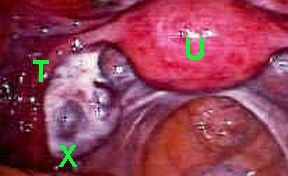 Picture of mature ovarian follicle at laparoscopy