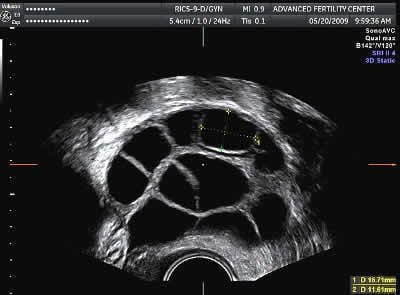 Ultrasound photo shows multiple follicles (black structures) in a stimulated ovary