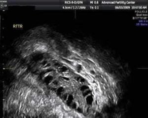 Polycystic ovary ultrasound picture